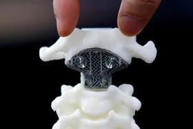 جراحی ستون فقرات با مهره چاپ ‌سه‌بعدی برای نخستین‌بار