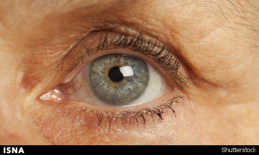 نجات بیماران مبتلا به آب سیاه از نابینایی با کاشت جدید 1