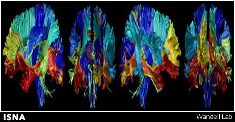 نمایش افزایش و کاهش حجم مغز در طول عمر انسان برای نخستین بار