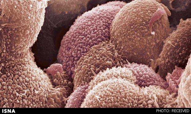 تشخیص دقیق‌تر سرطان تخمدان با آزمایش جدید