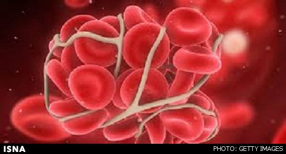 یافته‌های تحقیقات: افزایش خطر لخته شدن خون در مبتلایان به سرطان پستان