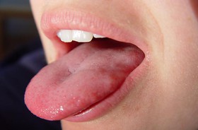 کمک به بیماران ام‌اس با شوک الکتریکی بر روی زبان