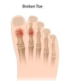 1416747577389_physiotherapy-in-perth-for-broken-toe.jpg