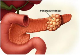 درمان سرطان پانکراس به کمک نانوذرات حامل دارو