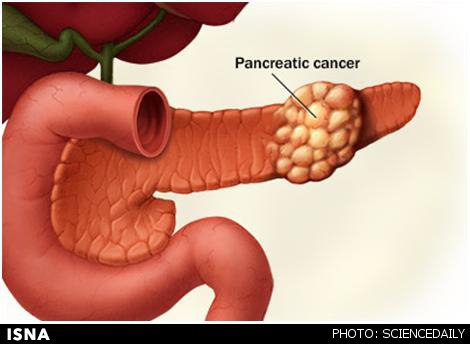 نانوحامل سیلیکا برای درمان سرطان پانکراس
