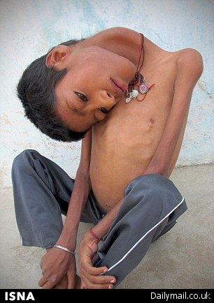 بیماری نادر پسربچه هندی + تصاویر