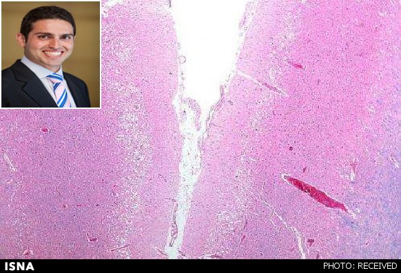 ابزار دانشمند ایرانی و همکارانش برای حذف لخته خون در سکته مغزی تایید شد