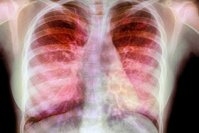 سیگار و آلودگی هوا از مهم‌ترین علل بیماری‌های ریوی