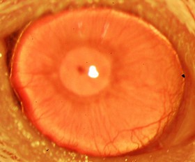 افزایش موفقیت جراحی پیوند قرنیه چشم با نانوذرات