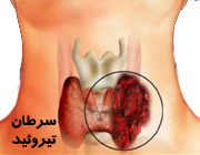 شمار مبتلایان به سرطان تیروئید اصفهان بیش از آمار کشوری است