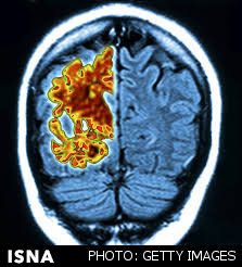 لمس غیرتهاجمی مغز برای تشخیص زودهنگام آلزایمر