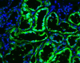 آنزیمی که شایع‌ترین سرطان کلیه را متوقف می‌کند