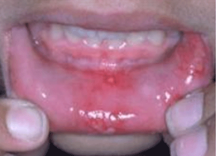مبتلایان به سرطان‌های حفره‌ی دهان در سیستان و بلوچستان مصرف‌کنندگان «پان» و «ناس»