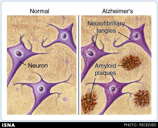 مشاهده نشانه‌های آلزایمر، 50 سال قبل از بروز بیماری