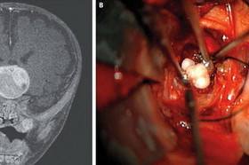 brain-tumor-teeth-140226.jpg