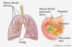 cystic-fbrosis.jpg