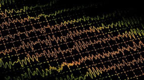 epilepsy-eeg-2.jpg