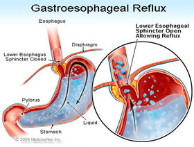 gastroesophageal_reflux.jpg