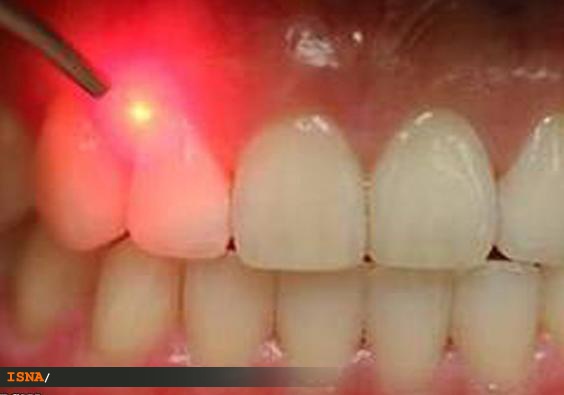 نوشین تقی زاده خوئی - تشخیص زودرس پوسیدگی دندان در مراحل بسیار اولیه شروع پوسیدگی با استفاده از لیزر و خاصیت طبیعی اتوفلورسانس بافت دندان
