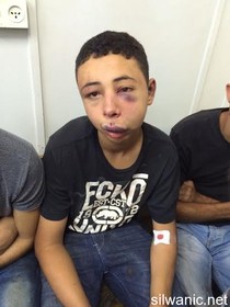 روایت نوجوان فلسطینی از ضرب و شتم به دست صهیونیست‌ها