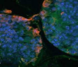 درمان سرطان خون با مغز استخوان مصنوعی