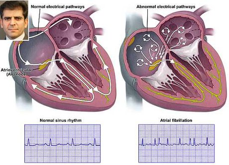 تخمین شیوع «فیبریلاسیون دهلیزی» در جهان برای نخستین بار توسط محقق ایرانی