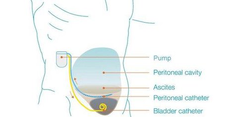 درمان جدید برای مبتلایان به سیروز کبدی با پمپ قابل شارژ