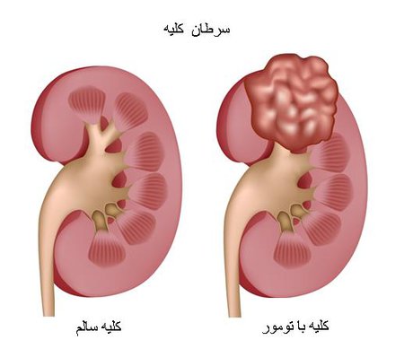 بازسازی کلیه با کمک ژن مرتبط با سرطان کلیه کودکان