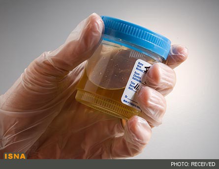 ابداع آزمایش جدید برای پیش‌بینی رد پیوند کلیه