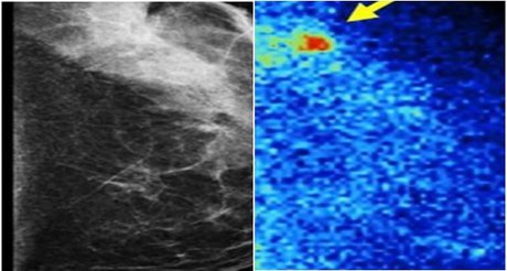 افزایش سرعت تشخیص تومورهای سرطان پستان با شیوه جدید