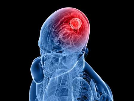 پژوهش‌ها درباره شیوع یک تومور مغزی خاص در ایران/ تحقیقات درباره درمان "اپی‌لپسی"