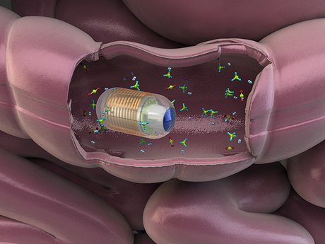 پیشگیری از سرطان گوارش با کپسول آشکارساز گازهای روده ساخت محقق ایرانی