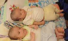 شناسایی 2 نوزاد مبتلا به بیماری "فنیل کتونوری" در زاهدان