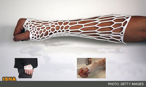 اسکلت خارجی چاپی، جایگزین گچ شکسته‌بندی سنتی