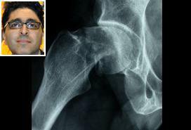 یافته‌های محقق ایرانی درباره تأثیر زمان جراحی بر بهبود شکستگی لگن