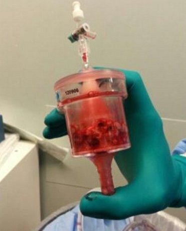 ساخت حسگری برای اندازه‌گیری داروی ضد لختگی خون توسط محققان ایرانی