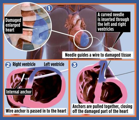 درمان بافت آسیب‌دیده قلب با روش جدید نخ‌کشی