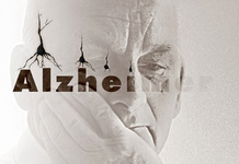 نشانه‌های اولیه آلزایمر