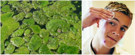 درمان آکنه پوست با جلبک‌های دریایی