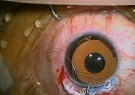 تغییر رنگ دائمی چشم‌ها در 15 دقیقه!