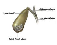 آیا برداشتن کیسه صفرا خطرناک است؟