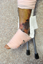  كمبود دارويي اين بار گريبان بيمار هموفيلي را گرفت