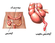 «آپاندیس» واقعا به چه دردی می‌خورد؟