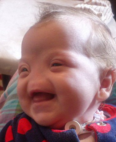 نوزادی که بینی ندارد+عکس