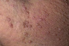 درمان جدید زگیل با واکسن سرخک و اوریون