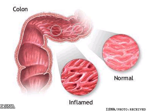 داروي معجزه‌گر براي كشتن تومورهاي سرطاني روده