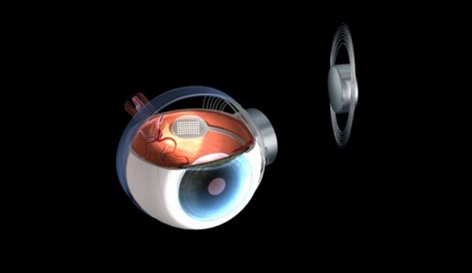 نتايج نويد بخش آزمايشات باليني پروتز شبكيه